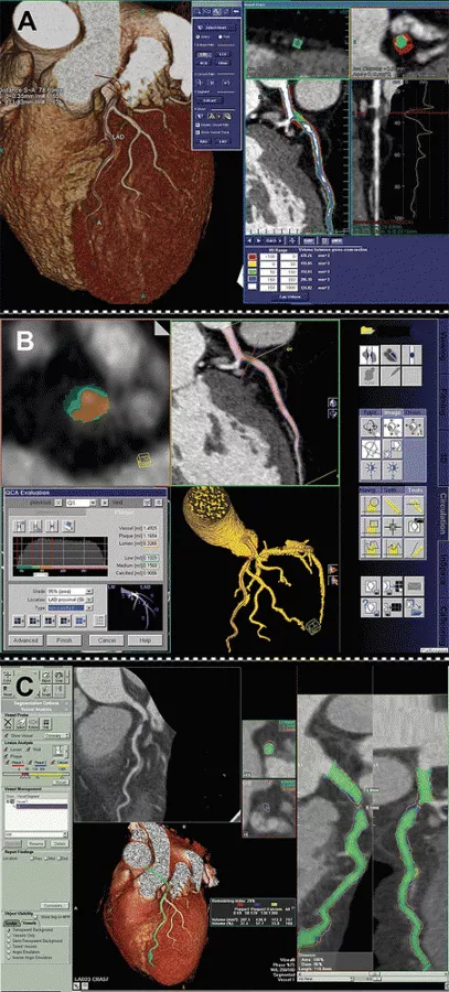 Cardiac CT post-processing software can help define the details of soft plaque, calcium, stents, blockages and anatomy. With the addition of FFR-CT, physiological information can also be gained from the noninvasive imaging. This can help determine if a patient can be treated medically or if they need to be revascularized using a stent. 