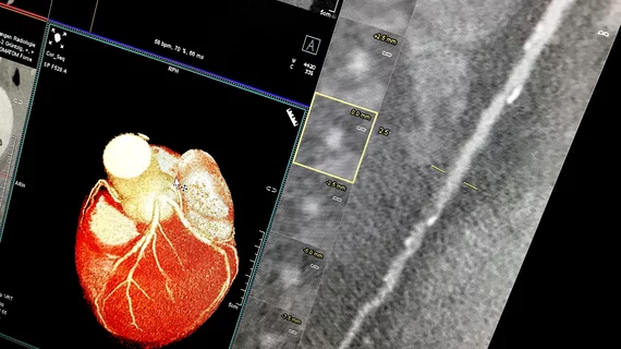 Example of a curved MPR image reconstruction of entire length of of a coronary artery on a cardiac CT scan to better show calcified and soft plaque burden inside the vessel. The thumbnail dots on the left side of the image are cross sectional views of the vessel. Siemens example on the expo floor.
