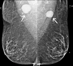 Don't delay mammograms after COVID vaccine. Women do not need to delay their mammogram appointment after COVID-19 vaccination. Women were told in 2021 to delay breast imaging if they got the COVID-19 vaccination because it can cause lymph node swelling and upper as cancer. A new RSNA study suggests not delaying mammograms because some women are presenting with cancer and they should not delay screening. Do not wait to get a mammogram after having a COVID vaccination.