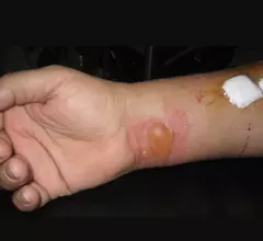 Example of a RF burn from an MRI scan where a sedated patient's identification bracelet was touching their skin during an exam. Image courtesy of RSNA. https://pubs.rsna.org/doi/10.1148/radiol.09090637