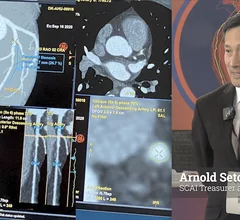 Arnold Seto, MD, MPA, FSCAI, Cath Lab Director, VA Long Beach Healthcare System, Long Beach, professor of medicine at Charles Drew University, and the Society for Cardiovascular Angiography and Interventions (SCAI) treasurer and and chair of the advocacy committee, explains how interventional cardiology is undergoing a transition to pre-planning percutaneous coronary interventions (PCI) using CT can information rather than than making decisions on the fly and making best guesses on device sizings. #YesCCT