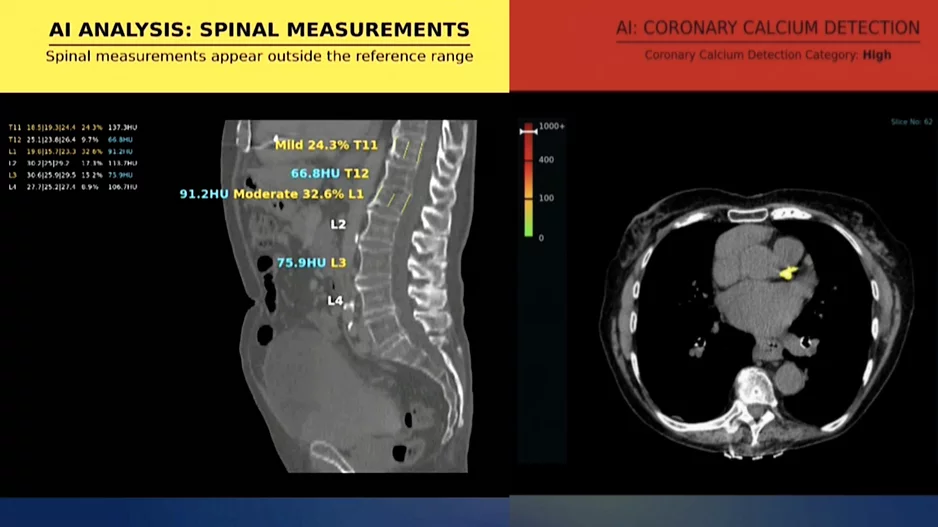 Examples of the messages the Nanox AI algorithms display for incidental findings of spinal compression fractures and detection of coronary calcium. Both can help physicians better understand risk factors or need for therapy in patients through these types of opportunistic screenings on scans being performed for other reasons.