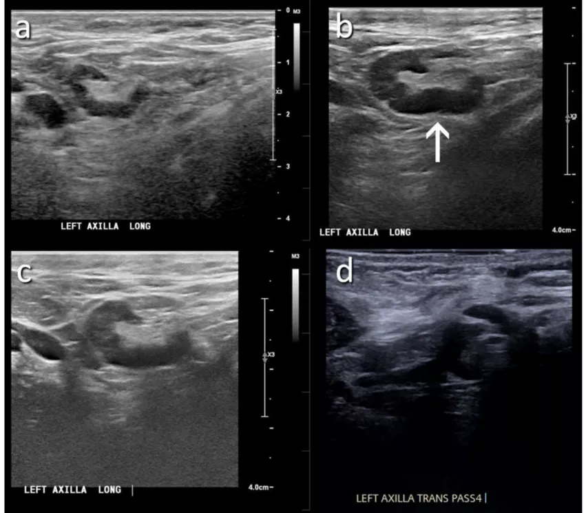 Don't delay mammograms after COVID vaccine. Women do not need to delay their mammogram appointment after COVID-19 vaccination. An example of COVID vaccine caused axillary adenopathy. The woman has a family history of breast cancer, but this lesion, seen on breast ultrasound, tested negative in an RSNA study. Women should not wait to get a mammograms after COVID vaccines.