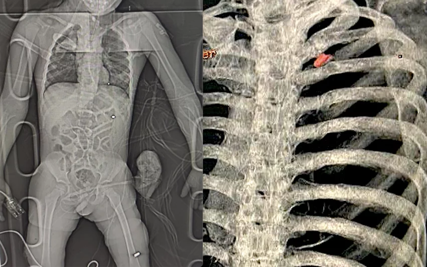 Radiology imaging of two wounded civilians with bullet and shrapnel embedded in tissue. Left is a digital X-ray of a patient with shrapnel in the chest and a bullet in the leg who was brought to the National Children's Specialized Hospital in Kyiv. Right, a 3D CT scan reconstruction of a bullet in the chest of a 40-year-old father who as attempting to evaculate his wife and child from the Russian advance near Kyiv when the Russians opened fire on him. Image from the Ukraine Heart Institute in Kyiv. Radiology imaging of two wounded civilians with bullet and shrapnel embedded in tissue. Left is a digital X-ray of a patient with shrapnel in the chest and a bullet in the leg who was brought to the National Children's Specialized Hospital in Kyiv. Right, a 3D CT scan reconstruction of a bullet in the chest of a 40-year-old father who as attempting to evaculate his wife and child from the Russian advance near Kyiv when the Russians opened fire on him. Image from the Ukraine Heart Institute in Kyiv.