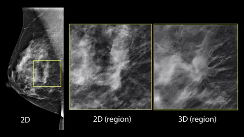 Example of a cancer that is difficult to see in dense breast tissue, but can be seen easier using 3D mammography digital breast tomosynthesis (DBT) breast imaging because the radiologist can go through the breast layer by layer if tissue..