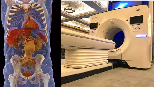 Advances in computed tomography scanner (CT) technology include photon-counting (Siemens image left) and faster, higher slice CT systems with integrated AI. Right image is GE Healthcare's Revolution on display at SCCT 2022. Trends in CT imaging by Signify Research.