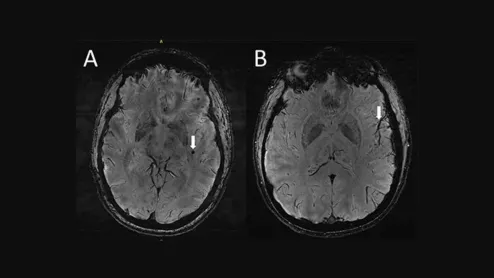 Ultra-high-res MRI Reveals Migraine Brain Changes