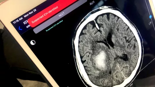 An example of artificial intelligence (AI) automated detection of a intracranial hemorrhage (ICH) in. a CT scan used to send alerts to the stroke acute care team before a radiologist even sees the exam. Example shown by TeraRecon at RSNA 2022.