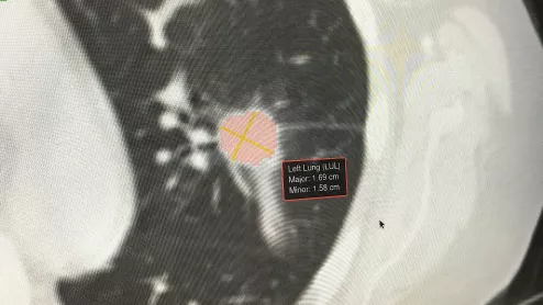 Example of artificial intelligence generated measurements to quantify the size of a lung cancer nodule during a followup CT scan to see if the lesion is regressing with treatment. This type of automation can aid radiologists by doing the tedious, time consuming work. Photo by Dave Fornell