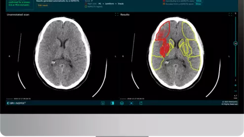 Brainomix stroke CT imaging 