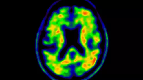 An example of a positive amyloid plaque PET nuclear brain scan. these tests can help identify Alzheimer's patients earlier so they can be prescribed drugs to treat the condition. 