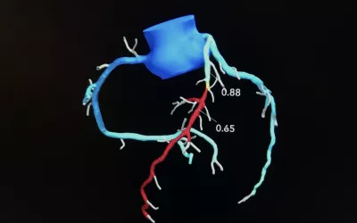 An example of a patient's FFR-CT 3D rendering of their entire coronary tree from their CT scan. The technology uses AI and computational fluid dynamics to determine the hemodynamic flow inside the vessels. It color codes areas of reduced flow. The radiologist or cardiologist can pick any location along a vessel to see the FFR values. This can determine if a patient needs to be revascularized, or managed with medications.
