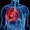 lung cancer pulmonary nodule