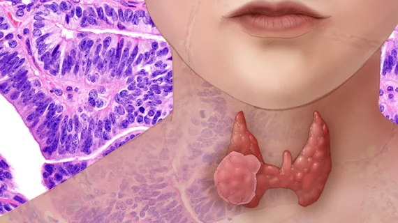 thyroid_cancer_26990475791.jpg thyroid_cancer_26990475791.jpg
