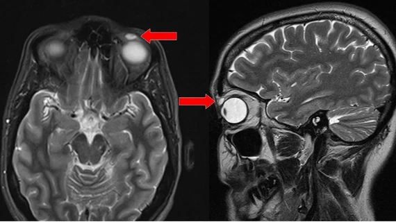 eyelid MRI BMJ Case Reports 2018. 