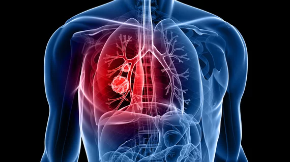lung cancer pulmonary nodule lung cancer pulmonary nodule
