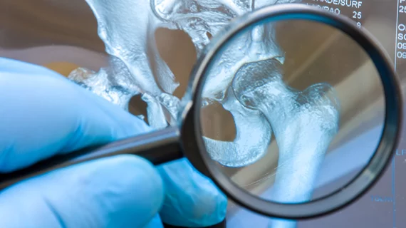 hip dysplasia joint socket hip dysplasia joint socket