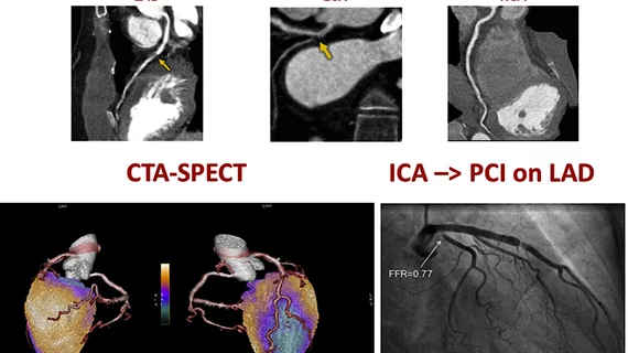A figure from the 2022 CAD non-invasive imaging guidelines showing a comparison of computed tomography angiography (CTA) and a SPECT-CT vs. an invasive angiogram from the cath lab showing the same blockage in a coronary artery. 